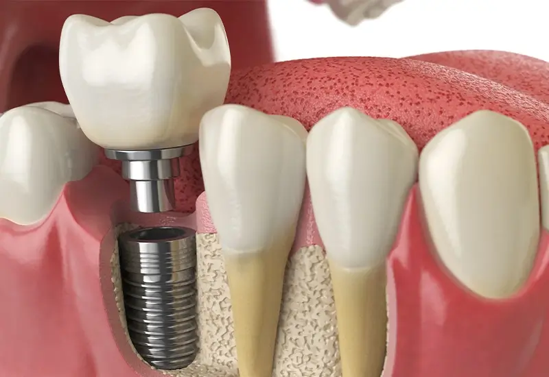 Kada su potrebni zubni implantati